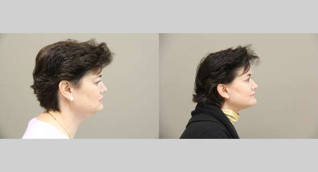 Facial Rejuvenation: Image #1317