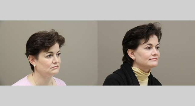 Facial Rejuvenation: Image #1318