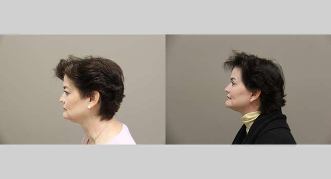 Facial Rejuvenation: Image #1319
