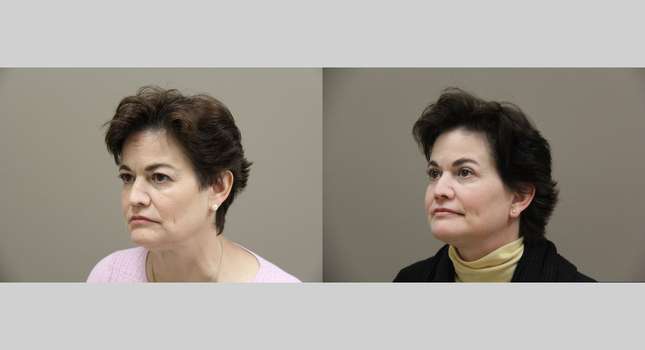 Facial Rejuvenation: Image #1320