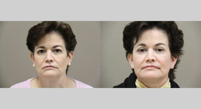 Facial Rejuvenation: Image #1321