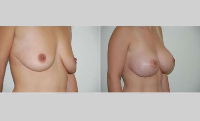 Breast Augmentation: Image #14
