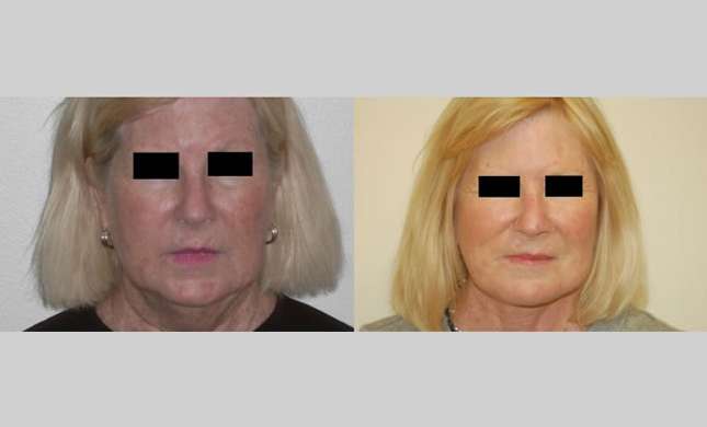 Facial Rejuvenation: Image #171