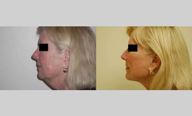 Facial Rejuvenation: Image #172