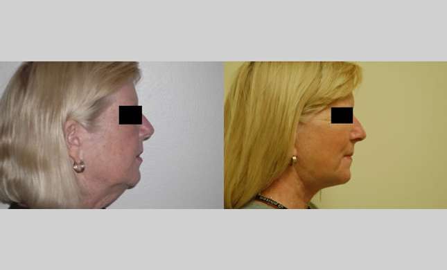 Facial Rejuvenation: Image #173