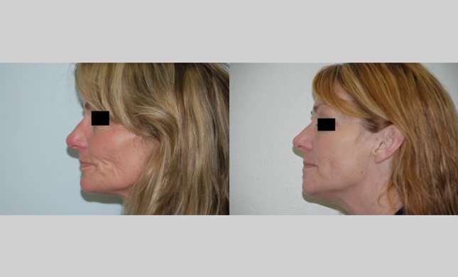 Facial Rejuvenation: Image #174