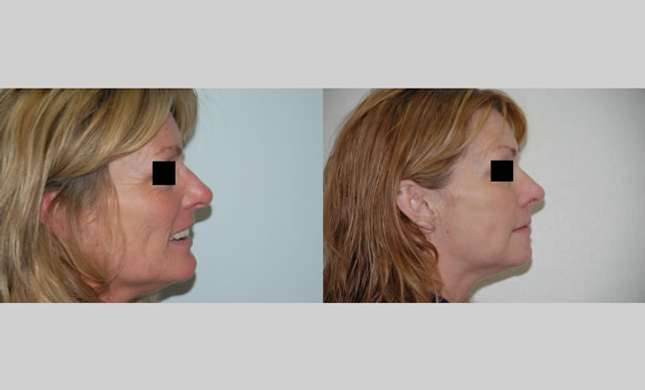 Facial Rejuvenation: Image #175
