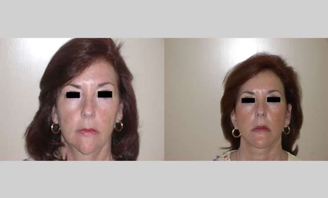 Facial Rejuvenation: Image #176
