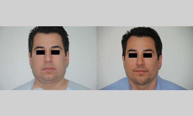 Facial Rejuvenation: Image #178