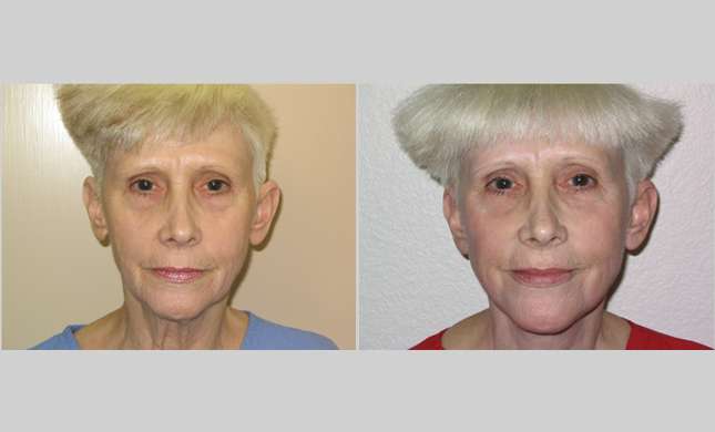 Facial Rejuvenation: Image #182