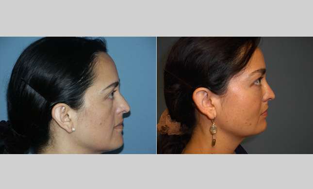 Facial Rejuvenation: Image #183