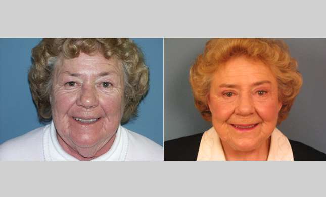 Facial Rejuvenation: Image #184
