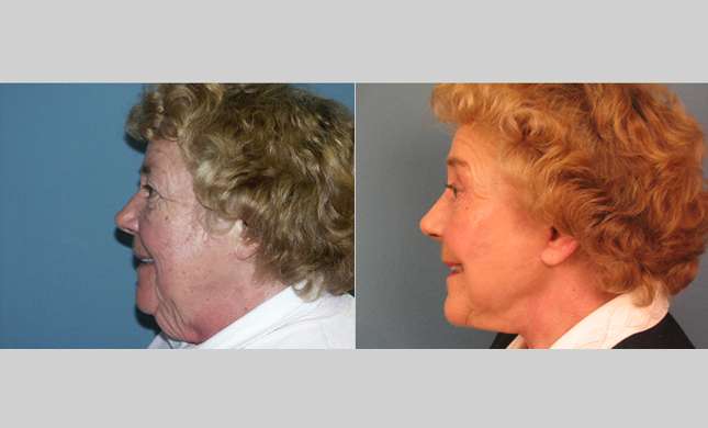 Facial Rejuvenation: Image #185