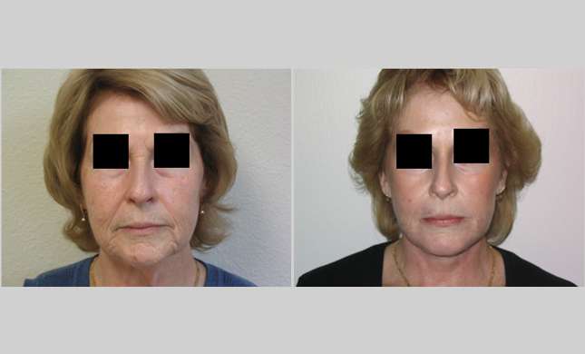 Facial Rejuvenation: Image #186