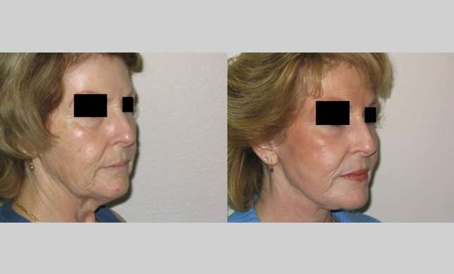 Facial Rejuvenation: Image #187