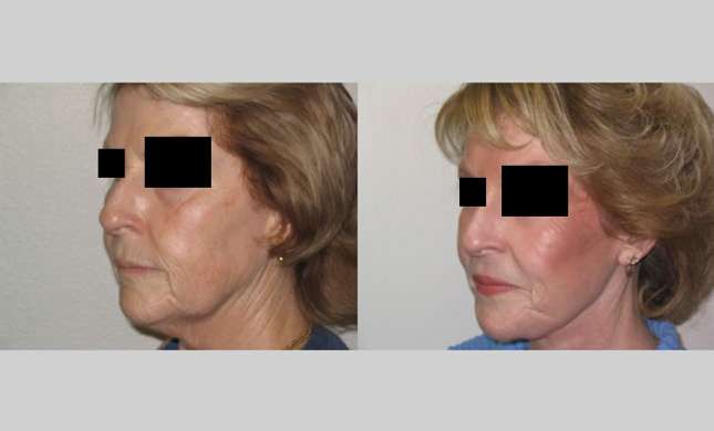 Facial Rejuvenation: Image #188