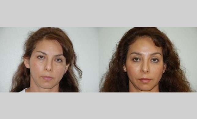 Facial Rejuvenation: Image #189