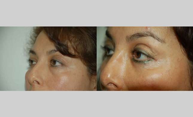 Facial Rejuvenation: Image #190