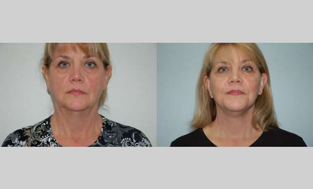 Facial Rejuvenation: Image #191