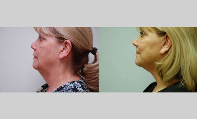 Facial Rejuvenation: Image #192