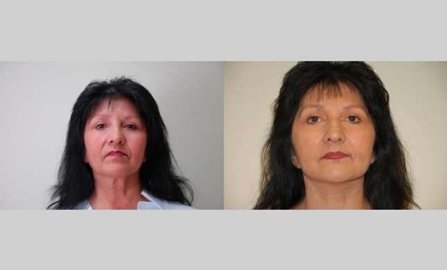 Facial Rejuvenation: Image #193