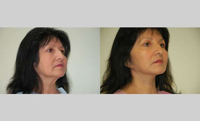Facial Rejuvenation: Image #194