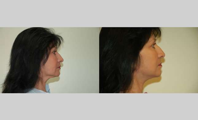 Facial Rejuvenation: Image #195