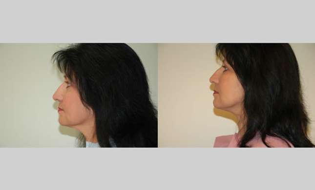 Facial Rejuvenation: Image #196