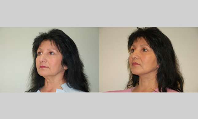 Facial Rejuvenation: Image #197