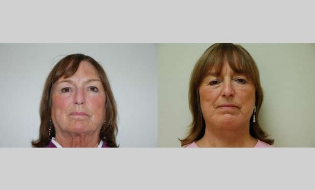 Facial Rejuvenation: Image #198