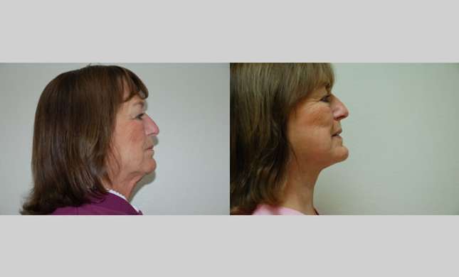 Facial Rejuvenation: Image #199