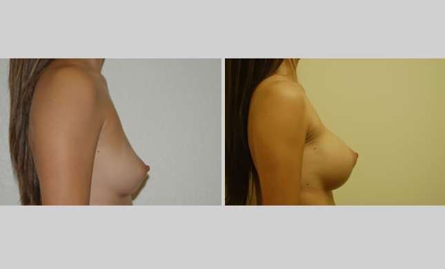 Breast Augmentation: Image #2