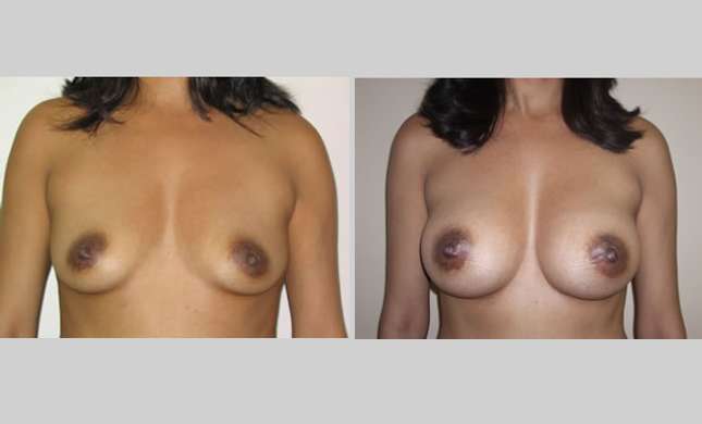 Breast Augmentation: Image #20