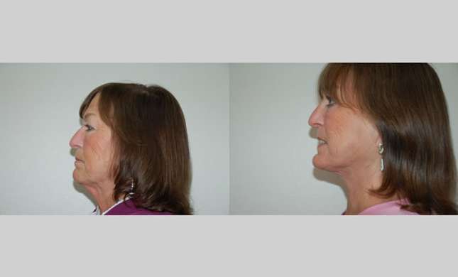 Facial Rejuvenation: Image #200