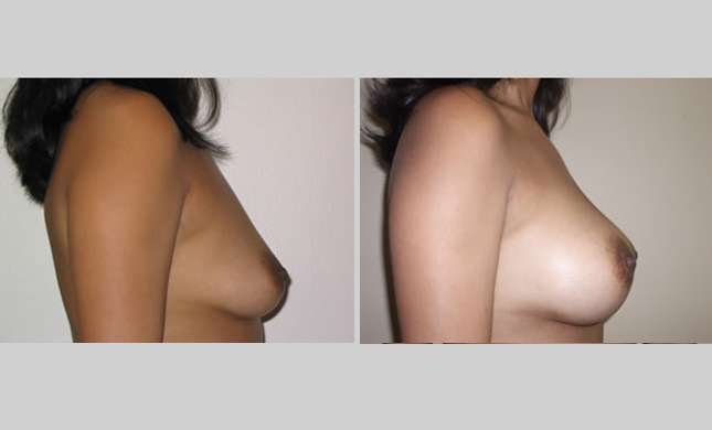 Breast Augmentation: Image #21