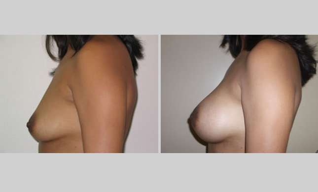 Breast Augmentation: Image #22