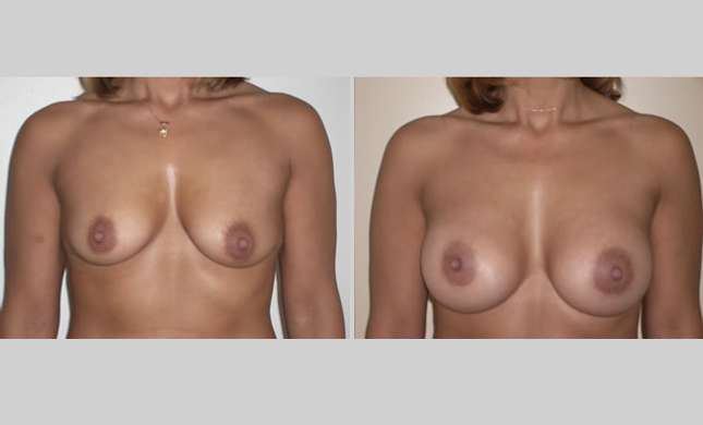 Breast Augmentation: Image #25