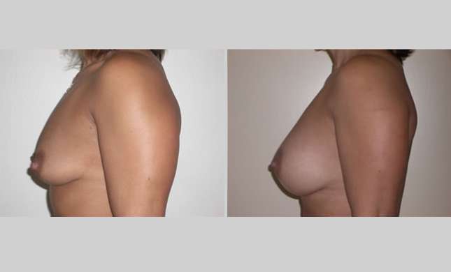Breast Augmentation: Image #26