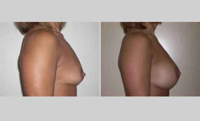 Breast Augmentation: Image #27