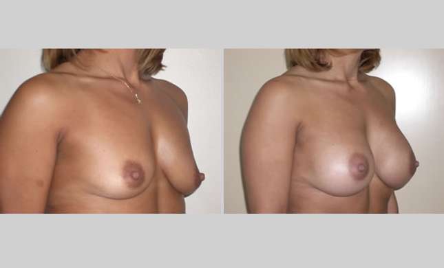 Breast Augmentation: Image #28