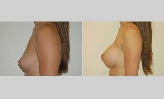 Breast Augmentation: Image #3