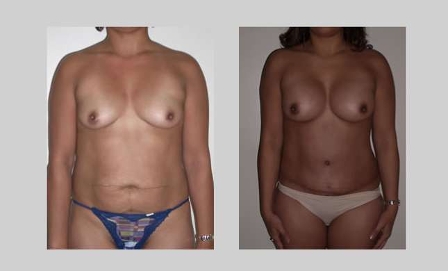Breast Augmentation: Image #30