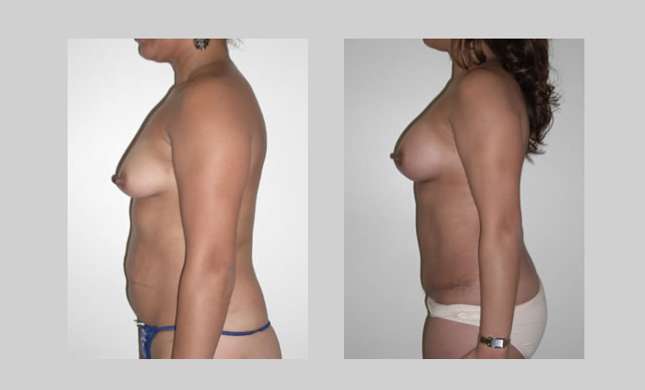 Breast Augmentation: Image #31