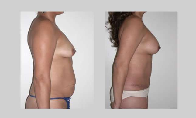 Breast Augmentation: Image #32