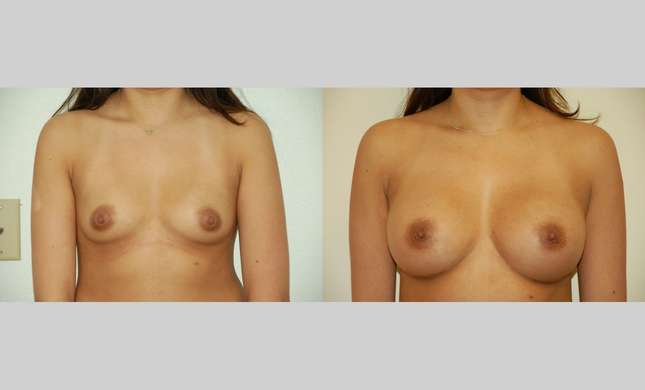 Breast Augmentation: Image #327