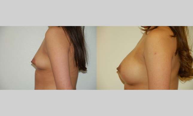 Breast Augmentation: Image #328