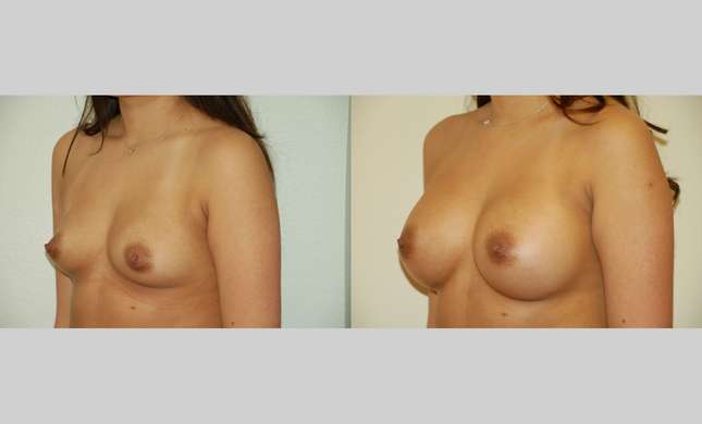 Breast Augmentation: Image #329