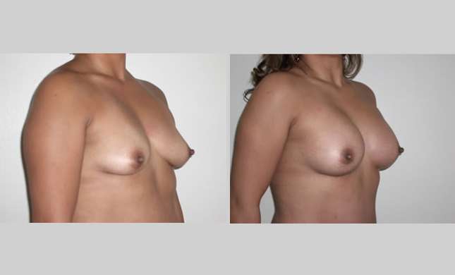 Breast Augmentation: Image #33