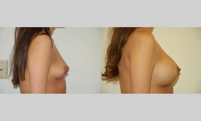 Breast Augmentation: Image #330