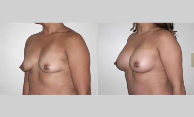 Breast Augmentation: Image #34